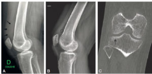 Figure 21.1 Traumatisme du genou droit chez une femme de 35 ans lors d'une chute. La radiographie standard du genou droit de profil montre un comblement radio-opaque du récessus sous-quadricipital (A) (flèches) correspondant à l'hémarthrose. Après traitement (B) (astérisque), cette image a disparu. L'hémarthrose est le signe indirect d'une fracture du plateau tibial latéral, visualisée en TDM (C) (flèche).