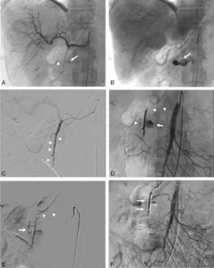 Figure 21.10 Prise en charge endovasculaire en radiologie interventionnelle d'un patient présentant un choc hémorragique à la suite de la prise en charge chirurgicale par pancréatectomie caudale et splénectomie (+ cholécystectomie) d'une tumeur intracanalaire papillaire et mucineuse du pancréas (TIPMP) des canaux secondaires dégénérée. La TDM a mis en évidence un saignement actif sur faux anévrisme d'une branche de l'artère gastroduodénale (AGD). Il s'agit du patient de la figure 21.7. A. Angiographie : par une voie d'abord fémorale droite, une sonde/cathéter a été positionnée dans le tronc cœliaque puis à l'origine de l'artère hépatique commune. L'injection de produit de contraste dans le cathéter met en évidence le faux anévrisme (flèche) développé sur une petite branche de l'AGD (tête de flèche ; probable arcade pancréatico-duodénale). B. Acquisition réalisée quelques secondes plus tard montrant l'importante fuite de produit de contraste (flèche) témoignant d'une hémorragie majeure. C. Un microcathéter a permis de cathétériser l'AGD et de l'emboliser à l'aide de multiples micro-coils (têtes de flèche). L'injection de produit de contraste permet de confirmer l'exclusion du segment de l'AGD porteur de la branche porteuse du faux anévrisme. D. Bilan angiographique de l'artère mésentérique supérieure (AMS). La sonde/cathéter a été positionnée à l'origine de l'AMS. L'injection de produit de contraste au travers de la sonde/cathéter permet de dévoiler la reprise du faux anévrisme et du saignement (flèche) par une arcade pancréaticoduodénale (têtes de flèche). Une embolisation complémentaire est donc absolument nécessaire. E. Un microcathéter (têtes de flèche) est positionné en distalité au sein de cette arcade pancréaticoduodénale. L'injection de produit de contraste permet de visualiser le segment porteur du faux anévrisme (flèche). F. Contrôle angiographique après embolisation de l'arcade pancréaticoduodénale par le microcathéter à l'aide de colle biologique (flèches), permettant de confirmer l'exclusion du faux anévrisme et l'arrêt du saignement.