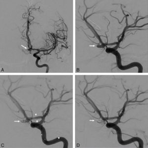 Figure 21.12 Prise en charge par embolisation en radiologie interventionnelle d'un patient de 28 ans ayant présenté une crise comitiale avec un score de Glasgow à 4 en post-critique suite à la rupture d'un anévrisme intracrânien de l'artère communicante antérieure. Il s'agit du patient de la figure 21.4. A. Bilan artériographique, incidence frontale, de l'artère carotide interne gauche, permettant la mise en évidence de l'anévrisme sacciforme (flèche) de l'artère communicante antérieure. B. Bilan artériographique, incidence oblique (incidence de travail) de l'artère carotide interne gauche, permettant la mise en évidence de l'anévrisme (flèche) de l'artère communicante antérieure. C. Embolisation par coils (flèche) de l'anévrisme à l'aide d'une micro-cathéter (têtes de flèche). D. Contrôle après embolisation permettant de confirmer l'exclusion de l'anévrisme (flèche).