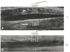 Figure 21.2 Aspect échographique à J1 et à J20 d'un hématome musculaire du mollet. À J1 (A), l'hématome est anéchogène sous la forme d'une bande noire entre les muscles gastrocnémien (GM) et soléaire. À J20 (B), l'hématome est échogène (entre les flèches) avec une atténuation plus importante des ultrasons et une augmentation de leur réflexion.