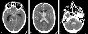 Figure 21.4 Patient de 28 ans ayant présenté une crise comitiale avec un score de Glasgow à 4 en post-critique. TDM cérébrale sans injection. A. Hyperdensité spontanée diffuse des espaces sous-arachnoïdiens (flèches) témoignant d'une hémorragie sous-arachnoïdienne. Il existe également une dilatation des ventricules latéraux. B. Hyperdensité spontanée au sein des ventricules (flèche) témoignant d'une hémorragie intraventriculaire. On retrouve également les signes d'hémorragie sous-arachnoïdienne (têtes de flèche). C. Centrée sur la fosse postérieure, la TDM montre une hémorragie au sein du 4e ventricule (flèche) et des citernes de la base.