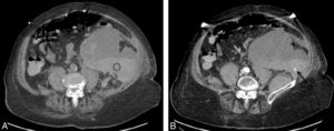 Figure 21.6 Femme de 80 ans admise aux urgences pour violentes douleurs abdominales après une chute sur le flanc gauche avec instabilité tensionnelle. La TDM sans injection (A) montre un volumineux hématome du muscle ilio-psoas gauche (hyperdensité spontanée) (astérisque). Après injection de produit de contraste au temps artériel (B), mise en évidence d'une fuite active de produit de contraste (flèche). Cette fuite active apparaît sous la forme d'une flammèche de produit de contraste hyperdense (de la même densité que l'aorte abdominale). La patiente a été prise en charge immédiatement en radiologie interventionnelle pour embolisation.