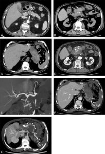 Figure 21.7 Patient présentant un choc hémorragique 3 jours après la prise en charge chirurgicale par pancréatectomie caudale et splénectomie (+ cholécystectomie) d'une tumeur intracanalaire papillaire et mucineuse du pancréas (TIPMP) des canaux secondaires dégénérée. A. TDM préopératoire après injection en phase artérielle différée montrant la lésion de TIPMP des canaux secondaire (flèche). Le patient présente un choc hémorragique 3 jours après la chirurgie. Une TDM est réalisée. B. TDM sans injection montrant une collection spontanément hyperdense (flèches) au contact et en avant du moignon pancréatique correspondant à un hématome frais. La structure spontanément très hyperdense désignée par la flèche en pointillés correspond à la ligne de suture chirurgicale. C. TDM sans injection montrant l'extension de l'hématome au contact et en avant de l'estomac (flèche) et au sein de la loge de splénectomie (têtes de flèche). D. TDM après injection en phase artérielle dévoilant une structure de forme nodulaire très dense au contact de la ligne de suture et de l'artère gastroduodénale correspondant à un faux anévrisme (flèche), accompagné d'une importante fuite de produit de contraste en avant (têtes de flèche). Il s'agit donc vraisemblablement d'un faux anévrisme rompu. E. Cette reconstruction coronale oblique et en maximum intensity projection (MIP) de l'acquisition en phase artérielle montre que le faux anévrisme (flèche) provient vraisemblablement d'une petite branche de l'artère gastroduodénale (AGD). AHC : artère hépatique commune. Les têtes de flèche désignent la ligne de suture chirurgicale, spontanément hyperdense. F. Nouvelle acquisition en phase veineuse montrant que la fuite de produit de contraste s'étend jusqu'à la loge de splénectomie (flèches), expliquant donc l'hématome à distance du site de résection pancréatique. G. Reconstruction axiale oblique en MIP de l'acquisition en phase veineuse montrant le trajet de la fuite vers la loge de splénectomie (têtes de flèche).