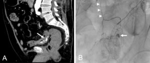 Figure 21.8 Patient présentant des rectorragies abondantes. A. TDM après injection en phase artérielle, en reconstruction sagittale, montrant une fuite du produit de contraste dans la lumière digestive (flèche) du côlon sigmoïde, témoignant d'un saignement actif d'origine artérielle (origine diverticulaire non visible ici). B. Angiographie. Par une voie d'abord fémorale droite, une sonde/cathéter a été positionnée à l'origine de l'artère mésentérique inférieure (AMI). Un microcathéter a ensuite été utilisé pour naviguer dans l'AMI et dans une branche plus distale (têtes de flèche). L'injection de produit de contraste dans le microcathéter met en évidence la fuite de produit de contraste, et donc le saignement actif, au sein du côlon sigmoïde (flèche). Une embolisation sélective pourra donc être réalisée.