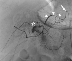 Figure 21.9 Patient présentant des hématémèses et un méléna sur saignement actif d'un ulcère du bulbe duodénal non contrôlable par voie endoscopique. Devant l'échec du traitement endoscopique, un traitement radiologique par embolisation est entrepris. Une sonde/cathéter (flèche) a tout d'abord été utilisée pour cathétériser le tronc cœliaque. Ensuite, un microcathéter (têtes de flèche) a été introduit dans l'artère hépatique commune, puis positionné au sein de l'artère gastroduodénale. L'injection de produit de contraste dans le microcathéter met en évidence une importante fuite de produit de contraste (étoile), et donc un saignement actif massif, provenant d'une branche de l'artère gastroduodénale.