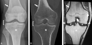 Figure 22.1 Aspect comparatif d'une articulation (genou) en radiographie (A), coupe frontale TDM (B) et coupe frontale IRM en pondération T1 (C). L'os cortical (flèche blanche) apparaît blanc en radiographie et TDM mais noir en IRM. La moelle osseuse (astérisque) est analysable en IRM. En radiographie et TDM, c'est l'os spongieux « trabéculaire » qui est analysable. Seule la hauteur de l'interligne articulaire (crochet) est analysable en TDM et en radiographie. En revanche, l'IRM permet d'analyser les ménisques (têtes de flèche), les ligaments (flèches larges) et les cartilages (#).