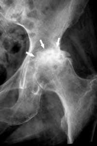 Figure 22.10 Radiographie de hanche gauche de face montrant une condensation de l'os sous-chondral (flèches) de part et d'autre de l'interligne coxofémoral pincé dans le cadre d'une arthrose coxofémorale.