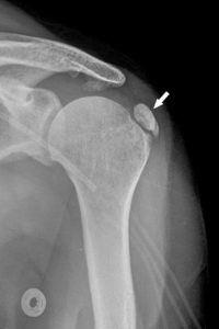 Figure 22.11 Radiographie de face de l'épaule gauche montrant une grande calcification dans un tendon de la coiffe des rotateurs dans le cadre d'un rhumatisme à cristaux de phosphate de calcium basique (PCB).