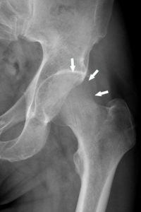 Figure 22.12 Radiographie de la hanche gauche montrant une déminéralisation de la tête fémorale qui apparaît moins dense que le grand trochanter, avec une perte de visibilité de la corticale supérieure (flèches) dans le cadre d'une algodystrophie.