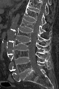 Figure 22.13 TDM (reconstruction sagittale en fenêtre osseuse) montrant une déminéralisation diffuse des corps vertébraux (flèches) qui apparaissent moins denses que les disques intervertébraux et aplatis, traduisant des tassements vertébraux dans le cadre d'une ostéoporose.