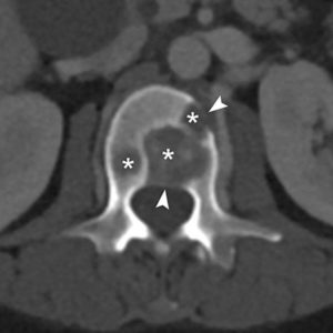 Figure 22.14 TDM (coupe axiale) passant par L2 montrant des ostéolyses multiples (métastases) (astérisques) dont certaines interrompent la corticale (têtes de flèche).