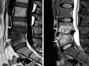 Figure 22.15 Spondylodiscite infectieuse en IRM. Coupes IRM (plan sagittal) (T1 à gauche, T2 à droite) montrant un œdème vertébral en hyposignal T1 et hypersignal T2 (flèches).