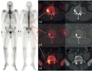 Figure 22.16 Scintigraphie et tomoscintigraphie osseuses chez un patient de 63 ans aux antécédents d'adénocarcinome prostatique en rechute biologique. Le balayage corps entier (images planaires, à gauche) retrouve de multiples hyperfixations vertébrales. La tomoscintigraphie (à droite, coupes axiales fusionnées avec la coupe TDM) permet d'identifier une hyperfixation intense bénigne en regard d'un processus ostéophytique en L2 (arthrose), une absence d'hyperfixation en regard d'une lésion condensante non métastatique du corps vertébral de L3 (îlot condensant bénin), et une hyperfixation intense du pédicule droit de L5 correspondant à une métastase débutante.