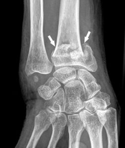Figure 22.2 Radiographie de face du poignet droit montrant une fracture de l'extrémité distale du radius (flèches).