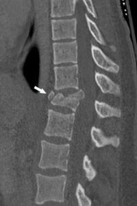 Figure 22.3 TDM (reconstruction sagittale en fenêtre osseuse) montrant une fracture du corps vertébral de T12 (flèche).