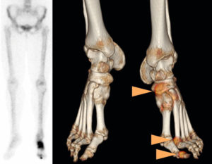 Figure 22.4 Scintigraphie et tomoscintigraphie osseuse fusionnée avec une TDM en 3D montrant des fissures multifocales (flèches) du pied gauche chez une patiente ostéoporotique. La reconstruction 3D (B) permet une meilleure évaluation anatomique que le cliché planaire (A). L'acquisition hybride avec TDM permet de plus la recherche d'anomalies morphologiques associées aux hyperfixations.