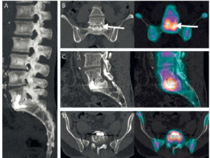 Figure 22.5 TEMP-TDM explorant une arthrodèse intersomatique L5-S1 implantée 2 ans auparavant chez un patient de 54 ans décrivant une lombalgie progressivement récurrente. A. TDM couplée en vue sagittale MIP. B, C, D. Vues TDM et TEMP-TDM en coupes frontales, sagittales, axiales. L'examen retrouve des solutions de continuité intensément hyperfixantes (flèches) des trabéculations intersomatiques (greffes) situées au sein de la cage, en faveur d'une pseudarthrodèse.