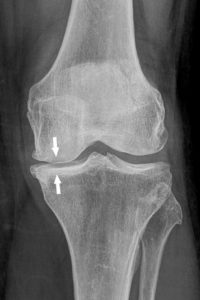 Figure 22.7 Radiographie de face du genou gauche montrant un pincement de l'interligne fémorotibial médial (flèches) dans le cadre d'une arthrose. Noter la condensation sous-chondrale associée.