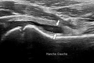 Figure 22.8 Échographie de la hanche d'un enfant en coupe longitudinale présentant une boiterie montrant un épanchement anéchogène (flèches) dans le cadre d'une synovite.