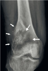 Figure 22.9 Radiographie de face du genou montrant un processus tumoral (ostéosarcome) déformant les contours du fémur (flèches) et avec une plage d'ostéolyse (flèches pointillées).