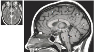 Figure 23.1 Coupe sagittale médiane pondérée en T1 de l'encéphale. Cerveau : 1. lobe frontal ; 2. lobe pariétal ; 3. lobe occipital ; 4. corps calleux. Tronc cérébral : 5. pédoncules cérébraux ; 6. pont ; 7. moelle allongée ; 8. moelle spinale ; 9. vermis cérébelleux ; 10. 3e ventricule ; 11. 4e ventricule ; 12. hypophyse. Tirets : extrémité du sillon central à la face interne du cerveau séparant le lobe frontal du lobe pariétal. La figure de gauche permet de repérer la position de la coupe sagittale sur une coupe axiale T2.