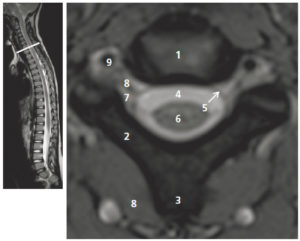Figure 23.10 Coupe axiale pondérée en T2 de la colonne cervicale par le disque intervertébral C7-T1. 1. Disque intervertébral C7-T1 ; 2. lame ; 3. processus épineux ; 4. LCS ; 5. dure-mère ; 6. moelle spinale ; 7. foramen intervertébral ; 8. nerf spinal C8 ; 9. artère vertébrale. La figure de gauche permet de repérer la position de la coupe axiale sur une coupe sagittale T2.