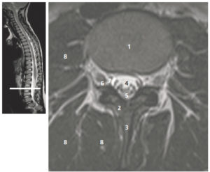 Figure 23.11 Coupe axiale pondérée en T2 de la colonne lombaire en L3. 1. Corps vertébral de L3 ; 2. lame ; 3. processus épineux ; 4. LCS ; 5. racines de la queue de cheval ; 6. nerf spinal L3 ; 7. foramen intervertébral L3-L4 ; 8. muscles rétrovertébraux. La figure de gauche permet de repérer la position de la coupe axiale sur une coupe sagittale T2.