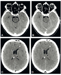 Figure 23.13 TDM cérébrale sans (A, C) et après injection (B, D) : la substance blanche (croix blanche) est moins dense que la substance grise intrathalamique (croix noire). Le LCS (flèche blanche) est hypodense. Après injection, les vaisseaux et les plexus choroïdes sont plus hyperdenses que sur la TDM sans injection (têtes de flèche noires). La graisse intra-orbitaire est hypodense (triangles blancs). L'air au sein des cellules ethmoïdales est hypodense (têtes de flèche blanches).