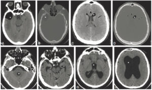 Figure 23.14 TDM cérébrale sans injection : hypodensités (étoiles). A, B. Tumeur graisseuse extra-axiale temporale droite (méningiome lipomateux) (graisse). C, D. Pneumencéphalie suite à une fracture de la base du crâne (air). E-H. Hydrocéphalie à pression normale responsable d'une dilatation ventriculaire (liquide).