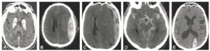 Figure 23.15 TDM cérébrales sans injection : hyperdensités spontanées intracrâniennes (croix noires). A. Calcifications des ganglions de la base du crâne. B. Hématome extradural. C. Hématome sous-dural aigu. D. Hémorragie sous-arachnoïdienne. E. Hématome intraparenchymateux.