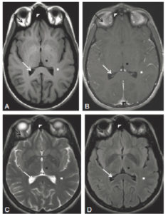 Figure 23.16 IRM cérébrale en pondération T1 (A), T1 après injection de gadolinium (B), T2 (C), et FLAIR (D). La substance blanche est en hypersignal T1 en hyposignal T2 et FLAIR (croix blanche). La substance grise thalamique est en hyposignal T1, en hypersignal T2 et FLAIR (croix noire). Le LCS intraventriculaire est en hyposignal T1, en hypersignal T2 et en hyposignal FLAIR (flèche blanche). La graisse intraorbitaire est en hypersignal T1, T2 et FLAIR (flèche noire). L'air est en hyposignal T1, T2 et FLAIR (tête de flèche blanche). Après injection de gadolinium, les structures vasculaires apparaissent plus hyperintenses qu'avant injection (tête de flèche noire).