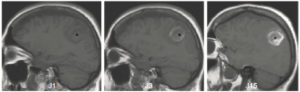 Figure 23.17 IRM cérébrales en pondération T1 sans injection : évolution du signal au cours du temps d'un hématome intraparenchymateux (croix noire) de l'isosignal vers l'hypersignal de J1 à J15.