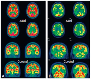 Figure 23.18 TEP au 18F-FDG. A. Images normales : la fixation du traceur est intense et homogène, symétrique sur l'ensemble du parenchyme cortical et sous-cortical, apparaissant en rouge uniforme sur cette échelle de couleur communément utilisée. B. Images anormales : la fixation du traceur est diminuée sur l'ensemble du cortex (aspect en jaune) avec des régions cérébrales où l'examen met en évidence un hypométabolisme (aspect en vert) temporopariétal bilatéral et frontal droit. En fonction du contexte, cet aspect peut se rencontrer dans la démence de type Alzheimer. Attention, cet examen rentre dans le cadre d'un bilan spécialisé multidisciplinaire. Il faut toujours interpréter un examen d'imagerie métabolique de façon complémentaire aux données cliniques, neuropsychologiques et d'IRM.