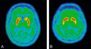 Figure 23.19 Coupes axiales de TEP à la 18F-DOPA. A. Image normale : la fixation du traceur s'effectue au niveau des striatum, structures profondes sous-corticales ; la fixation est homogène et symétrique en avant sur les noyaux caudés et en arrière sur les putamens. B. Image anormale : la fixation est diminuée au niveau du putamen gauche avec un aspect aminci et jaune sur l'échelle de couleur utilisée. Le patient présente donc une dénervation dopaminergique présynaptique du putamen gauche en rapport avec un syndrome parkinsonien clinique à droite.