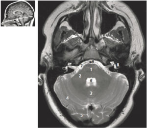 Figure 23.2 Coupe axiale pondérée en T2 de la fosse postérieure. 1. Pont ; 2. pédoncule cérébelleux ; 3. vermis cérébelleux ; 4. hémisphère cérébelleux ; 5. lobe occipital ; 6. 4e ventricule ; 7. espace sous-arachnoïdien de la base du crâne (ou citernes de la base) ; 8. oreille interne ; 9. artère basilaire. La figure de gauche permet de repérer la position de la coupe axiale sur une coupe sagittale T1.