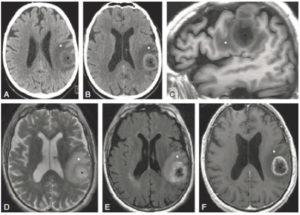 Figure 23.20 TDM cérébrale sans (A) et avec injection (B) ; IRM cérébrale en T1 sans injection (C), en T2 (D), en FLAIR (E) et T1 après injection de gadolinium (F). Lésion tumorale intraparenchymateuse (croix noire), hypodense en TDM (A), en hyposignal T1 (C), en hypersignal T2 (D) et FLAIR (E), et rehaussée en périphérie après injection en TDM (B) et en IRM (F). La lésion est entourée d'œdème vasogénique (croix blanche) hypodense en TDM, en hyposignal T1 et en hypersignal T2 et FLAIR en IRM.