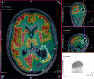 Figure 23.21 Coupes transversale, sagittale et coronale de TEP au 18F-FDG fusionnée avec l'IRM dans le cadre d'une suspicion de récidive d'un glioblastome occipital gauche, opéré il y a 10 mois. Foyer hypermétabolique anormal à la partie postéro-inférieure de la prise de contraste en IRM compatible avec une récidive de haut grade comme la tumeur initiale.