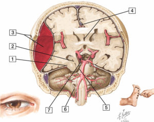 Figure 23.22 Différents types d'engagement cérébral dans un contexte d'hématome extradural temporo-pariétal droit. 1. Tente du cervelet ; 2. engagement temporal ; 3. fracture temporopariétale droite et hématome extradural droit ; 4. déviation de la faux du cerveau vers la gauche et engagement sous-falcoriel avec déviation du 3e ventricule ; 5. compression du pédoncule cérébral droit se traduisant par une hémiparésie gauche ; 6. engagement de l'amygdale cérébelleuse droite ; 7. compression du 3e nerf crânien se traduisant par un ptosis, un strabisme divergent et une mydriase homolatérale. Source : Felten DL. Netter's Neuroscience Flash Cards. Fourth Edition. Elsevier ; 2015.