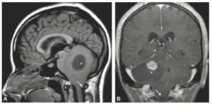 Figure 23.23 IRM cérébrale en coupe sagittale T1 sans injection (A) et coupe coronale T1 après injection de gadolinium. Volumineuse lésion kystique cérébelleuse droite avec nodule mural prenant le contraste (astrocytome pilocytique) (croix blanche). Important effet de masse avec engagement bilatéral des amygdales cérébelleuses dans le foramen magnum (flèche blanche).