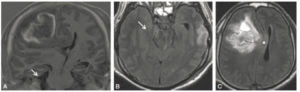 Figure 23.24 IRM cérébrale en coupe coronale en T1 (A) et en coupes axiales FLAIR (B, C). Hématome intraparenchymateux responsable d'un engagement sous-falcoriel (croix blanche) et temporal (flèche).