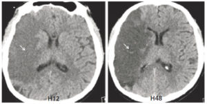 Figure 23.25 TDM cérébrale sans injection : hypodensité frontale droite (flèche blanche) correspondant à un AVC ischémique dans le territoire de l'artère cérébrale moyenne (ou sylvien) à 12 et à 48 heures du début des symptômes neurologiques.