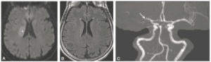 Figure 23.26 IRM cérébrale en coupes axiales diffusion (A), FLAIR (B) et angio-IRM du cercle artériel du cerveau (C). Hypersignal en diffusion (croix blanche) correspondant à un AVC ischémique dans le territoire de l'artère cérébrale moyenne droite (ou sylvien droit). Celui-ci n'est pas encore visible en FLAIR, ce qui témoigne du caractère très récent (inférieur à 6 heures). L'angio-IRM montre une occlusion de l'artère cérébrale moyenne droite (flèche).