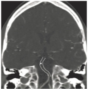 Figure 23.27 Angio-TDM du cercle artériel du cerveau montrant l'absence de rehaussement de la partie supérieure de l'artère basilaire témoignant d'une occlusion (croix blanche). Le thrombus est représenté entre les traits en pointillés.