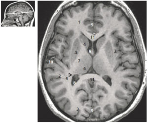 Figure 23.3 Coupe axiale du cerveau pondérée en T1 avec injection de gadolinium (coupe de Flechsig). 1. Lobe frontal ; 2. lobe pariétal ; 3. lobe occipital. Ganglions de la base du crâne (noyaux gris centraux) : 4. noyau caudé ; 5. noyau lenticulaire ; 6. thalamus ; 7. capsule interne ; 8. ventricule latéral ; 9. scissure interhémisphérique ; 10. scissure frontopariétale (de Sylvius) ; 11. corps calleux. La figure de gauche permet de repérer la position de la coupe axiale sur une coupe sagittale T1.
