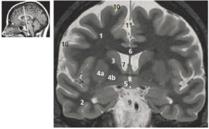 Figure 23.4 Coupe coronale (ou frontale) pondérée en T2 du cerveau (coupe de Charcot). 1. Lobe frontal ; 2. lobe temporal ; 3. noyau caudé ; 4. noyau lenticulaire (a : putamen, b : pallidum) ; 5. thalamus ; 6. corps calleux ; 7. ventricule latéral ; 8. 3e ventricule ; 9. espace sous-arachnoïdien de la base du crâne (citernes) ; 10. espaces sous-arachnoïdiens péricérébraux ; 11. scissure interhémisphérique. La figure de gauche permet de repérer la position de la coupe axiale sur une coupe sagittale T1.