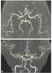 Figure 23.7 Angio-IRM par temps de vol (sans injection de produit de contraste) des artères de l'encéphale, reconstructions par projection des pixels d'intensité maximale. Vues supérieure (A) et antérieure (B). 1. Artère carotide interne ; 2. artère vertébrale ; 3. artère basilaire ; 4. artère cérébrale moyenne (sylvienne) ; 5. artère cérébrale antérieure ; 6. artère cérébrale postérieure. Les pointillés entourent le cercle artériel du cerveau (polygone de Willis)