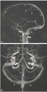 Figure 23.8 Angio-IRM par temps de vol (sans injection de produit de contraste) des veines de l'encéphale, reconstructions par projection des pixels d'intensité maximale. Vues latérale (A) et supérieure (B). 1. Veine corticale ; 2. sinus sagittal (longitudinal) supérieur ; 3. sinus droit ; 4. sinus transverse (ou latéral) ; 5. sinus sigmoïde ; 6. veine jugulaire interne ; 7. torcular.