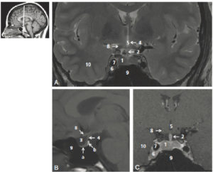 Figure 23.9 Coupes coronale pondérée en T2 (A), sagittale médiane pondérée en T1 (B) et coronale pondérée en T1 après injection de gadolinium (C) de l'hypophyse. 1. Hypophyse (a : lobe antérieur, b : lobe postérieur) ; 2. infundibulum (tige) hypophysaire ; 3. selle turcique ; 4. hypothalamus ; 5. 3e ventricule ; 6. sinus caverneux ; 7. carotide interne ; 8. chiasma optique (II) ; 9. sinus sphénoïdal ; 10. lobe temporal. La figure de gauche permet de repérer la position de la coupe coronale sur une coupe sagittale T1.