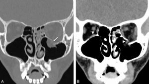 Figure 24.10 Traumatisme contondant de l'orbite avec déficit de l'élévation du regard : fracture du plancher de l'orbite gauche par enfoncement (blow-in), avec incarcération du muscle droit inférieur au sein du foyer fracturaire. A. La TDM du massif facial en fenêtre osseuse met en évidence le trait de fracture du plancher de l'orbite (flèche). B. La fenêtre tissus mous met en évidence le muscle droit inférieur incarcéré dans le foyer de fracture à gauche, à comparer au côté droit normal (têtes de flèche).