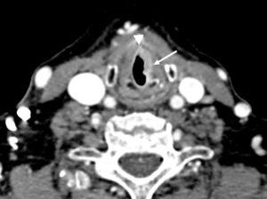 Figure 24.11 Carcinome de la corde vocale gauche. TDM injectée en coupe axiale centrée sur l'étage glottique. Épaississement tumoral irrégulier rehaussé par le contraste de l'ensemble de la corde vocale gauche (flèche) avec extension à la commissure antérieure (tête de flèche).